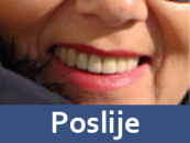 zubne-proteze-poslije