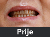 zubne-proteze-prije